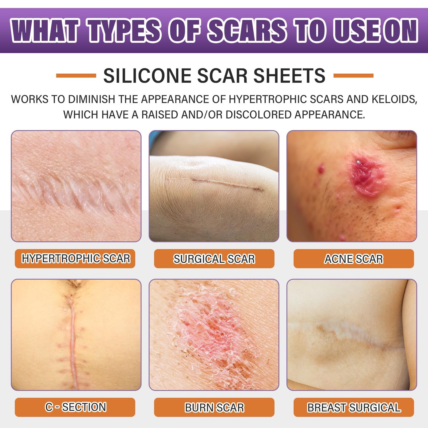 Silicone Scar Sheets Roll – Flexible Silicone Scar Tape for Skin Care